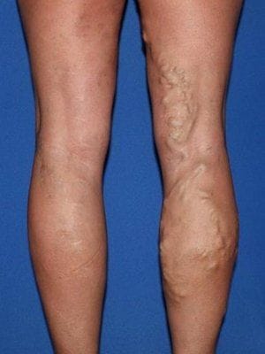 Learn About Varicose Veins Vascular Surgery Melbourne