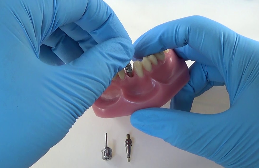 Elevate your skills with our Hands-on Implant Restorative Course