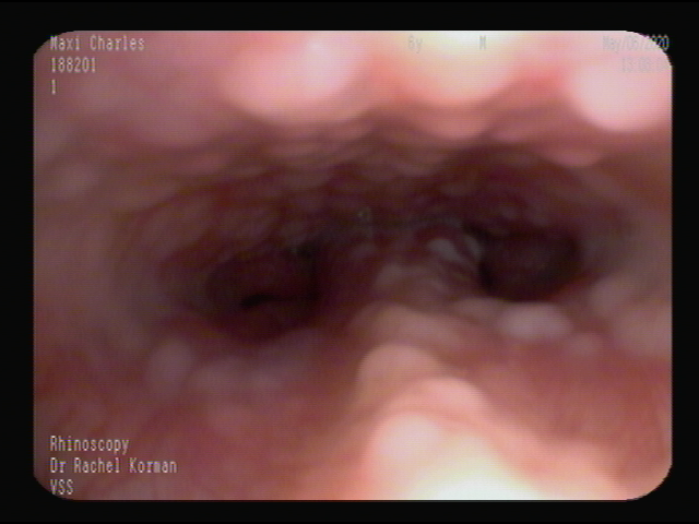 Nodules of inflammation