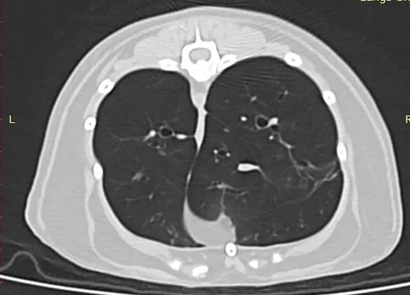 Lungs on CT