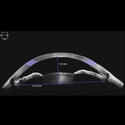 Anterior Chamber Imaging