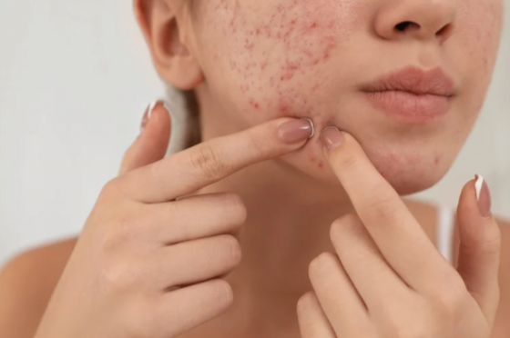 The Gut-Skin Connection in Acne: How Your Digestive Health Impacts Your Skin