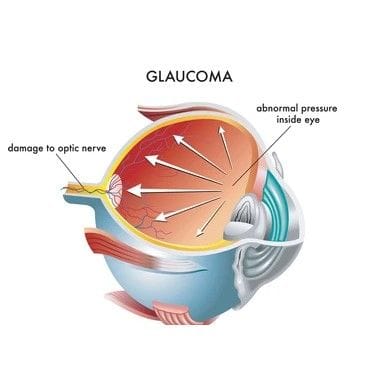 Glaucoma Eye Image