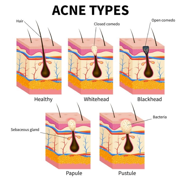 Chart with types of acne