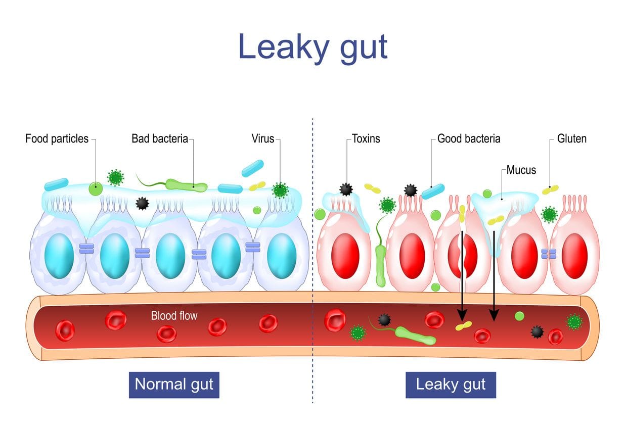 Leaky gut Syndrome, difference between Healthy cells, and inflamed intestinal cells.