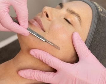 What are the benefits of microneedling?