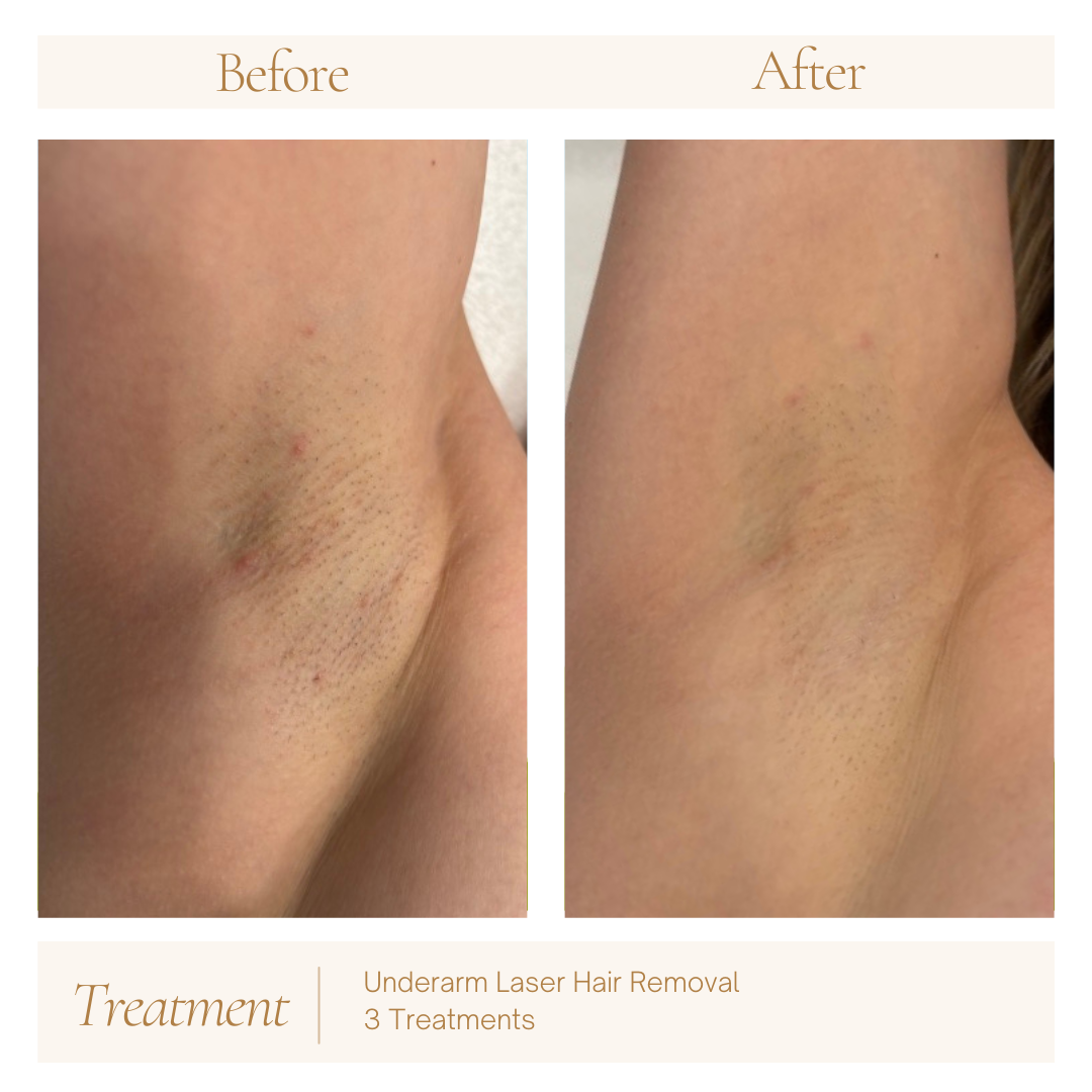 Unveiling Laser Hair Removal: Your FAQs Answered!