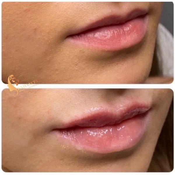 Enhanced Medical Aesthetics Lip Fillers