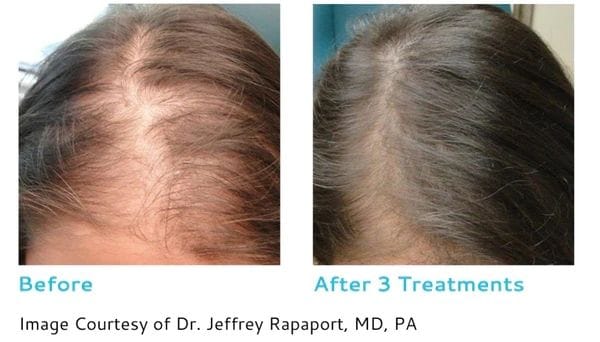 PRP for Hair Loss | Enhanced Medical Aesthetics