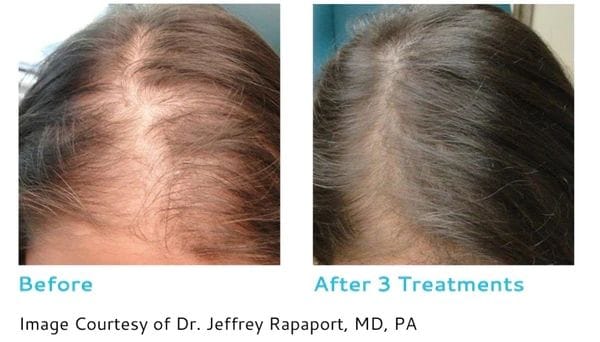 PRP for Hair Loss | Enhanced Medical Aesthetics PRP for Hair Loss | Enhanced Medical Aesthetics