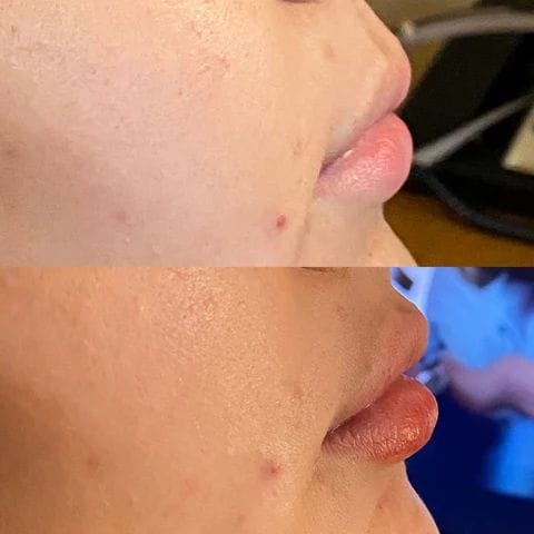 She had one syringe of Restylane Kuses added to her lips as she wanted more plump lips