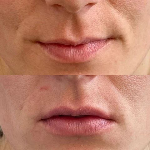 This lovely lady 1/2 syringe of Restylane Kysse for lip injections