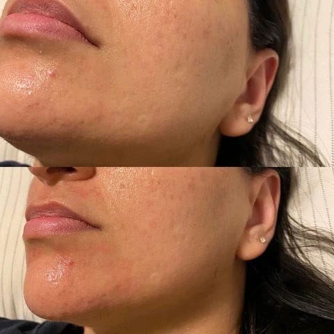 This lady had microneedling done, the after picture is immediately after
