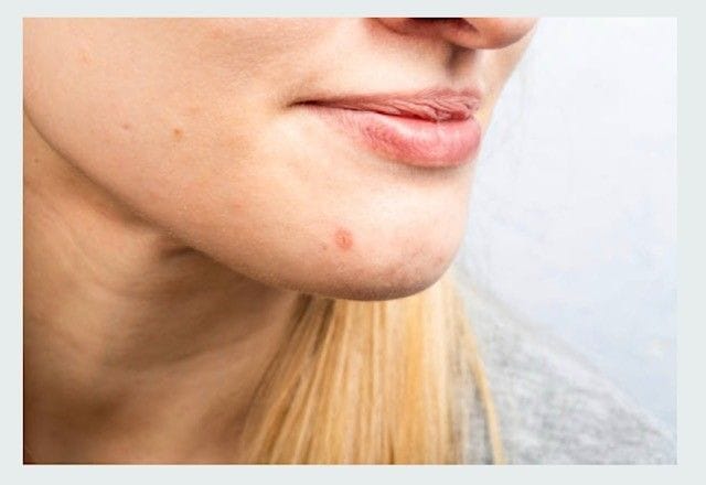 Bioidentical Progesterone Cream: A Treatment For Acne