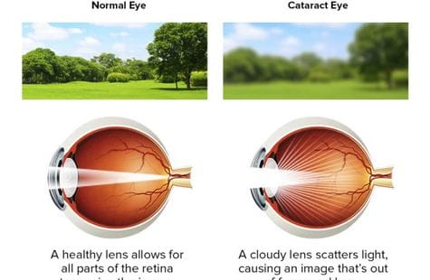 WHY SHOULD I LOOK OUT FOR CATARACTS?