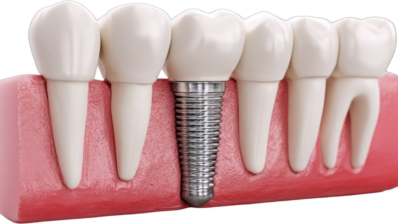 What You Should Know Before Getting Dental Implants