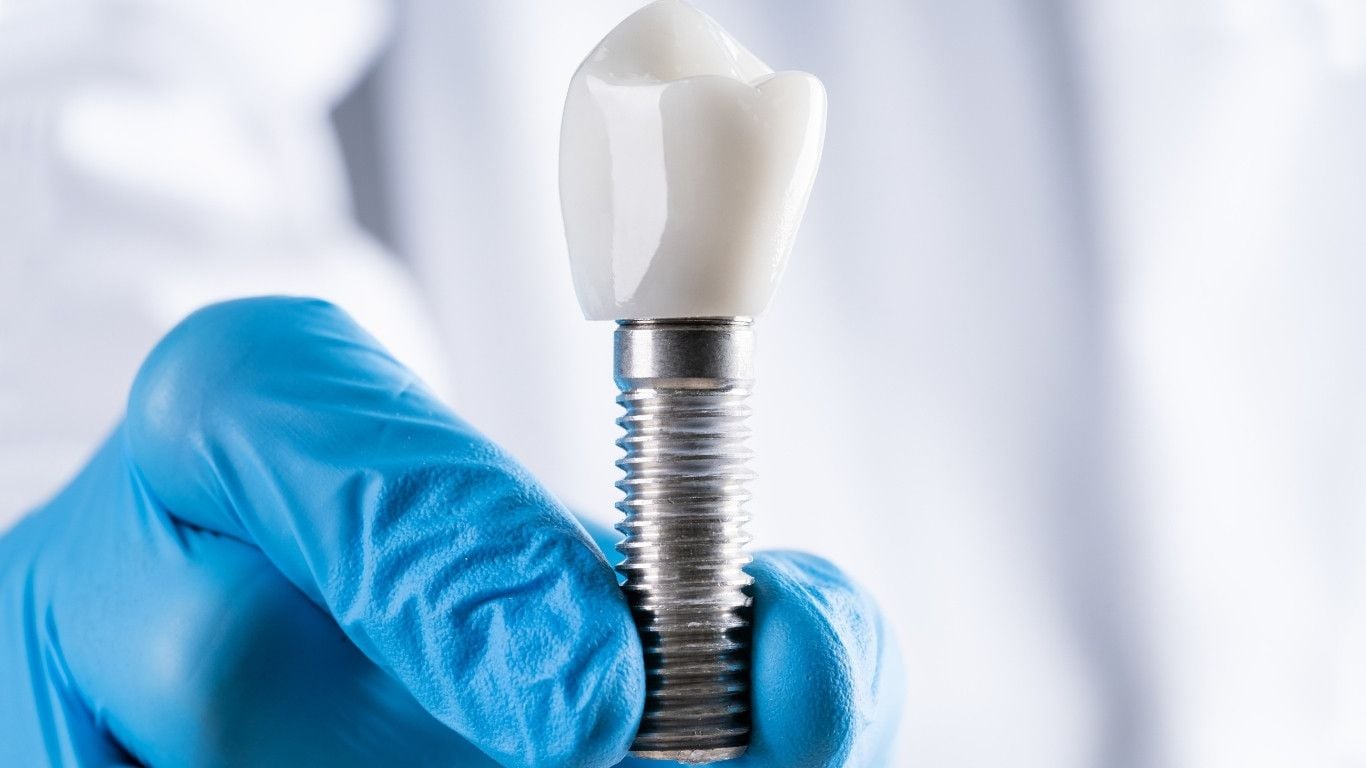 Are Dental Implants Covered by Insurance in Alberta?