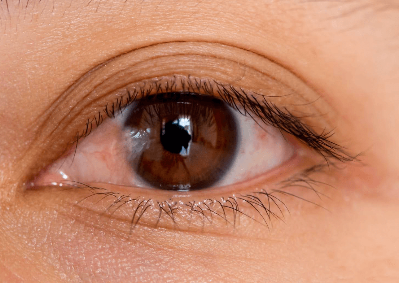 Pterygium Treatment: When Should You Consider Surgery? Pterygium Treatment: When Should You Consider Surgery?