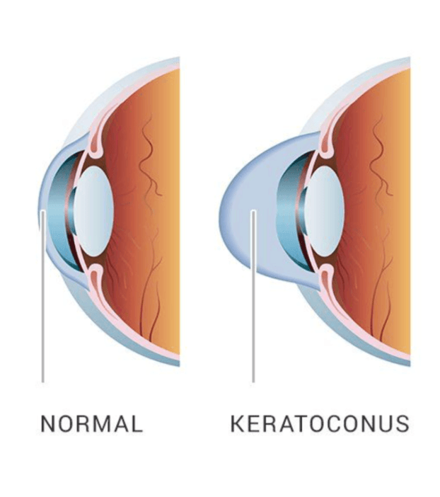 Keratoconus: What It Is and How It&rsquo;s Treated
