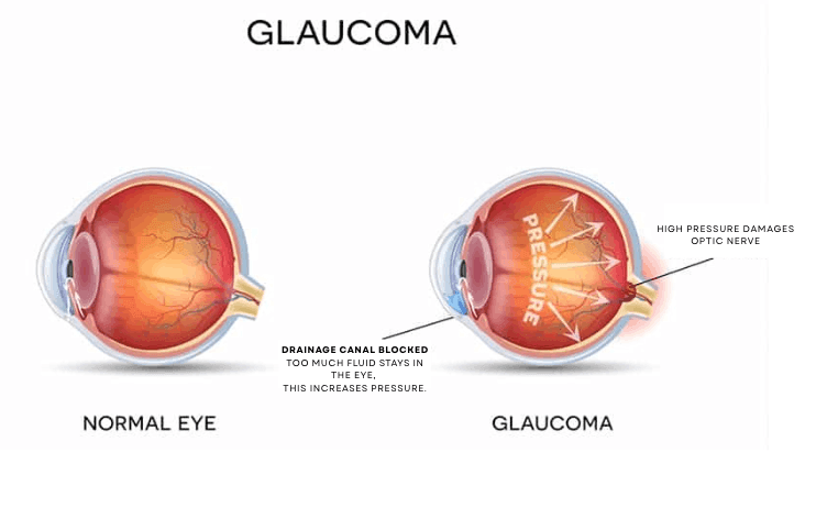 Why Early Glaucoma Treatment Matters Why Early Glaucoma Treatment Matters