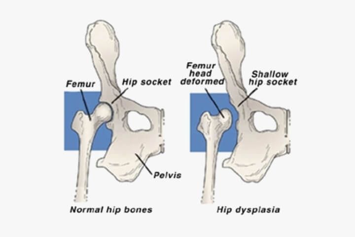 Hip Dysplasia