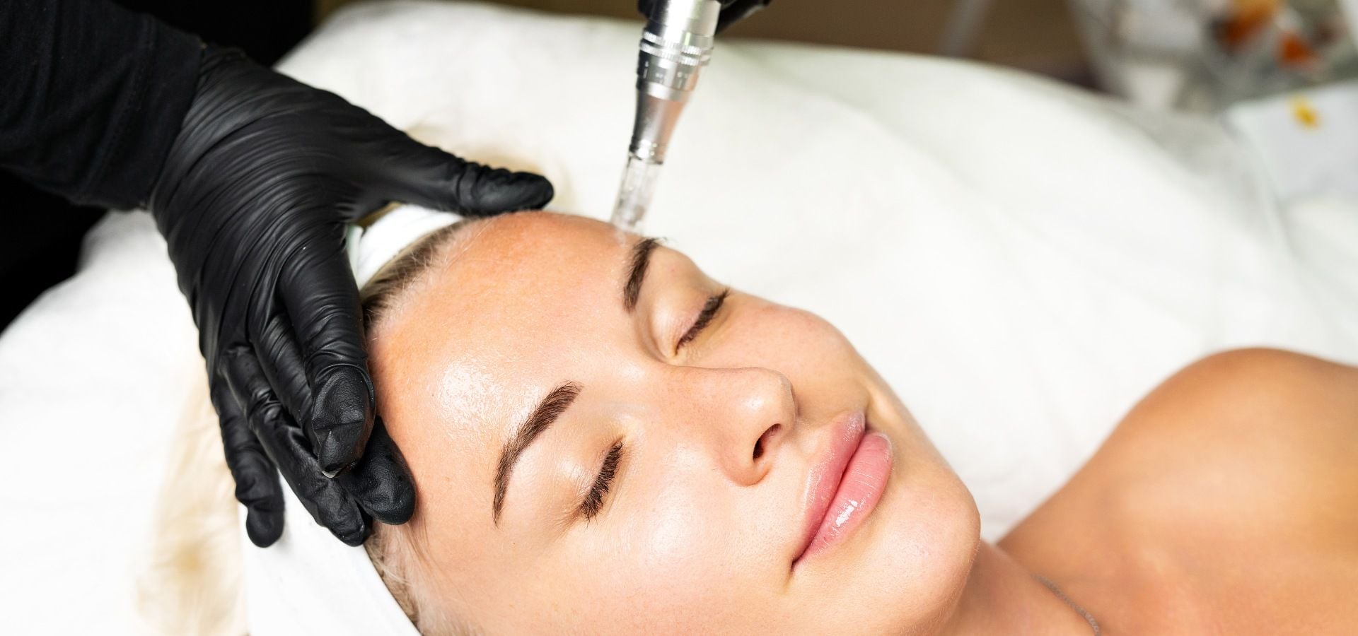 Microneedling with PRP: The Ultimate Skin Renewal Combination