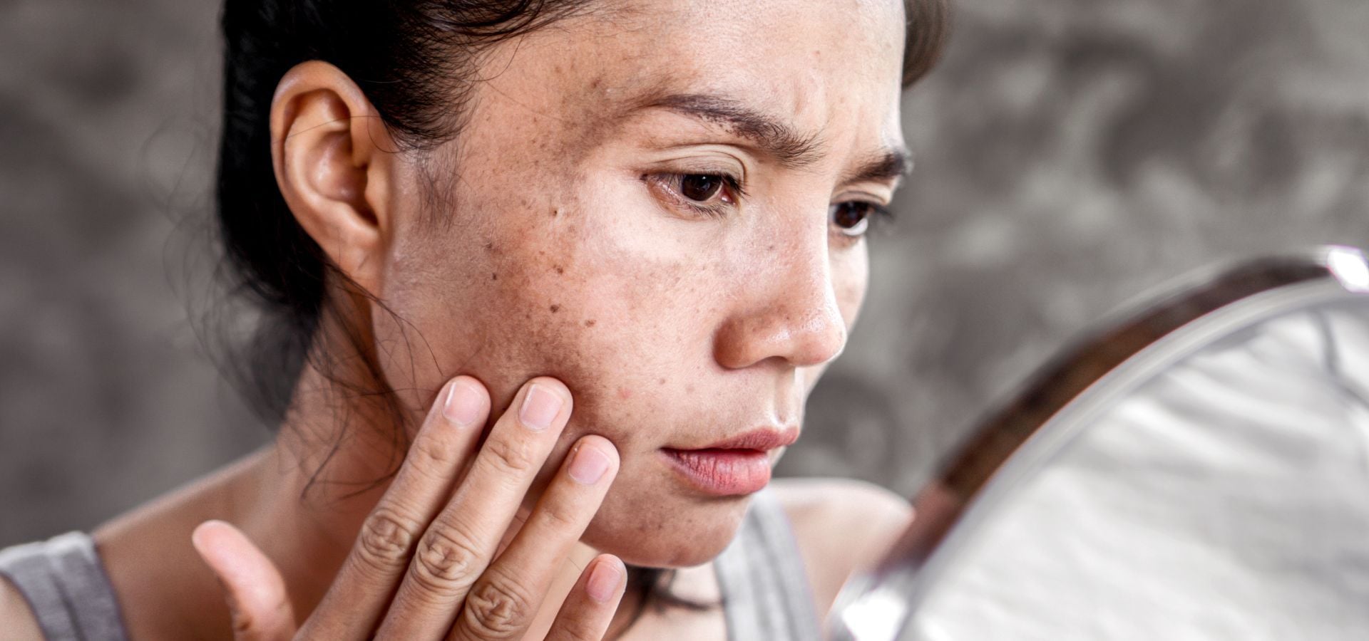 Hyperpigmentation: Causes, Types and Treatment Options