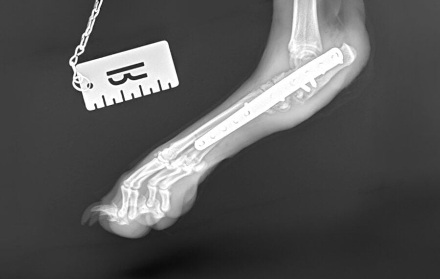 Intertarsal Arthrodesis (partial fusion of the ankle)
