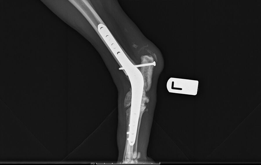Pantarsal Arthrodesis (full fusion of the ankle)