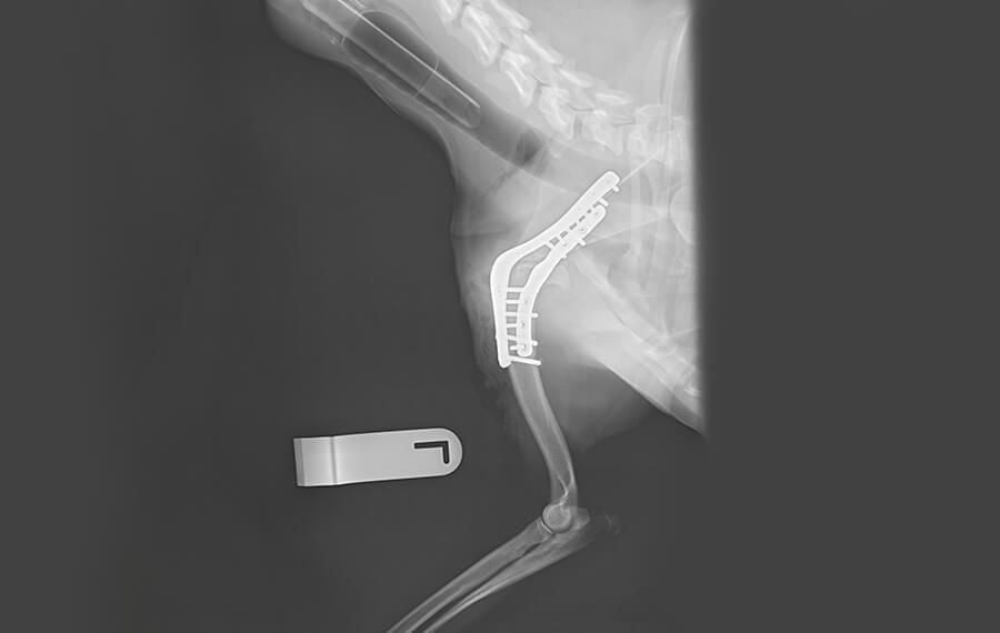 Shoulder Arthrodesis (fusion of the shoulder)