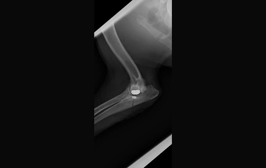 Total Elbow Replacement