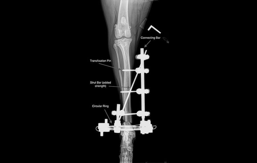 External Skeletal Fixation (ESF)