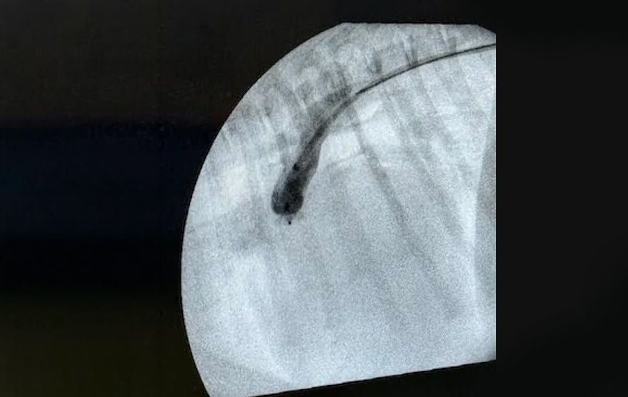 Minimally invasive PDA closure Minimally invasive PDA closure