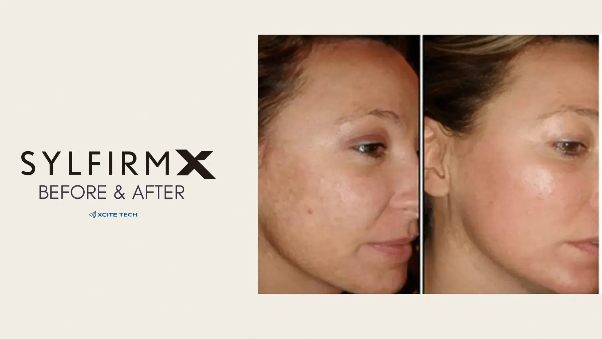 Rejuvenate Your Skin with Sylfirm X RF Microneedling