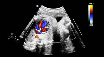 Fractional Area Change (FAC) in 2025: A Fresh Look at ASE Guidelines & Severity Grading Fractional Area Change (FAC) in 2025: A Fresh Look at ASE Guidelines & Severity Grading