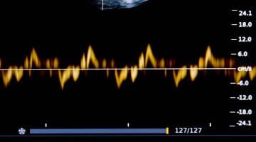 S′ Wave in 2025: New Grading, Measurement Tips, and Pitfalls S′ Wave in 2025: New Grading, Measurement Tips, and Pitfalls