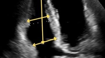 RV Basal Diameter 2025: Updated ASE Grading Explained