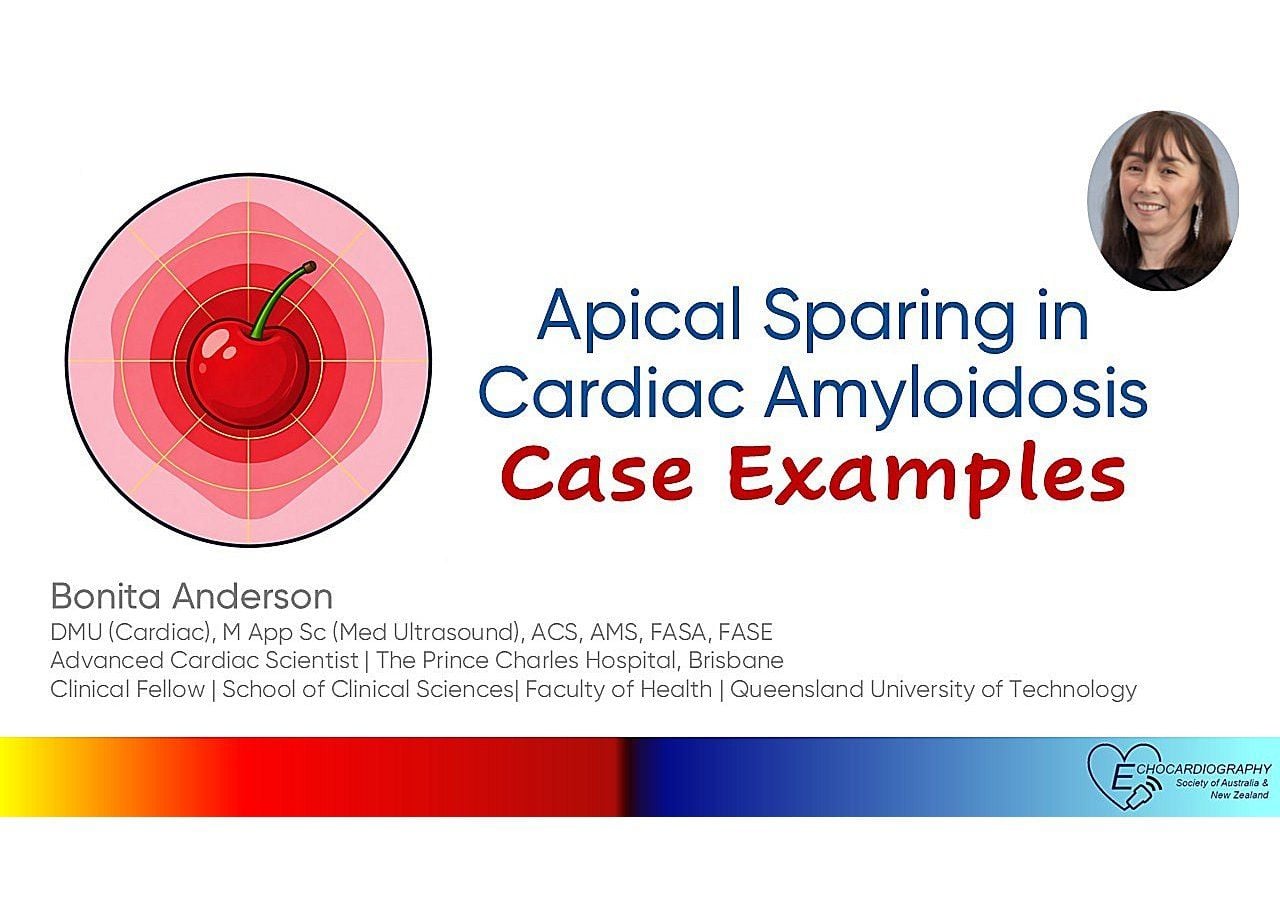 Apical Sparing in Cardiac Amyloidosis: Case Examples