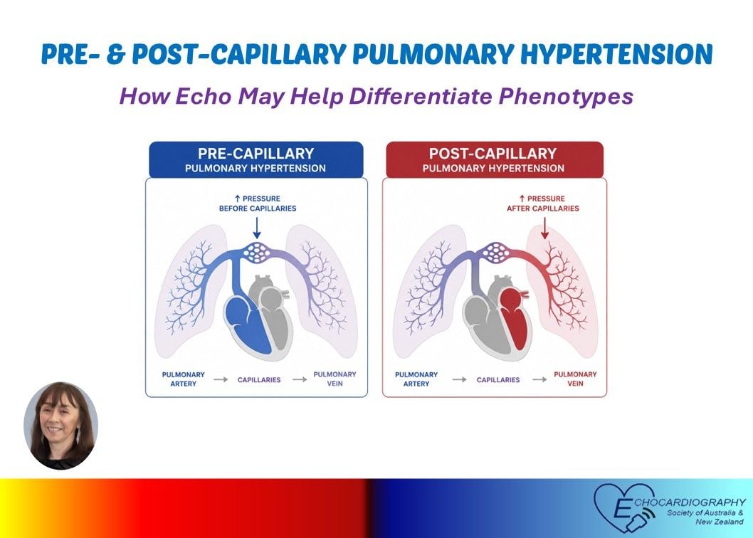 Distinguishing between pre- and post-capillary pulmonary hypertension is essential for guiding appropriate treatment. In this blog, Bonita Anderson discusses how echocardiography may aid in making thi Distinguishing between pre- and post-capillary pulmonary hypertension is essential for guiding appropriate treatment. In this blog, Bonita Anderson discusses how echocardiography may aid in making thi