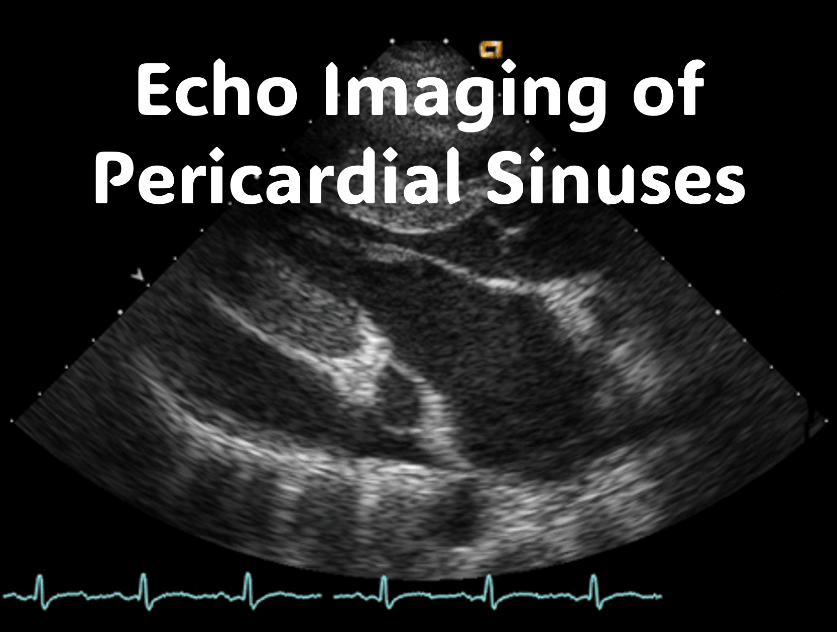 Mind the Gaps: Identifying Pericardial Sinuses on TTE