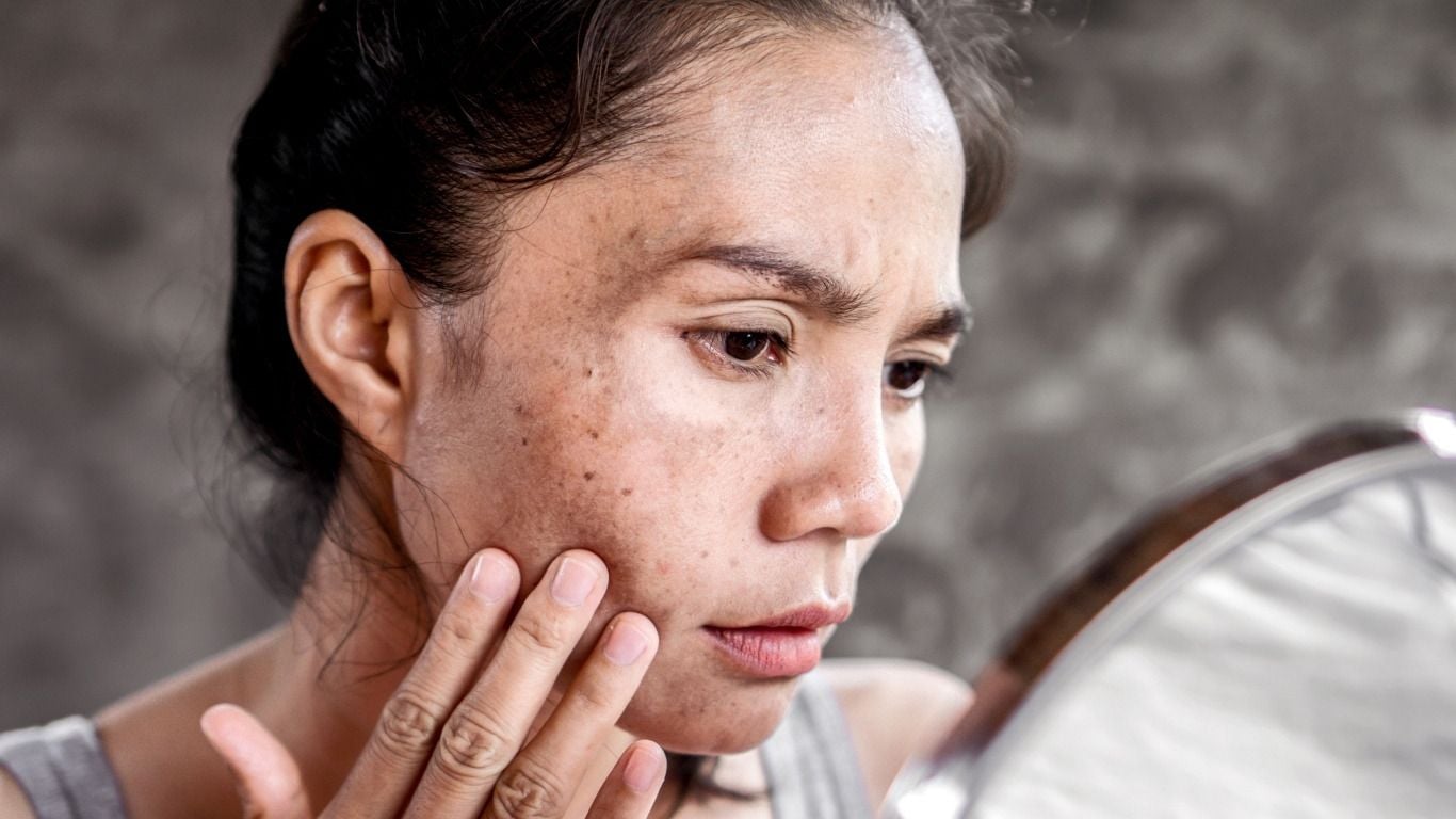 Melasma Treatment: The Ultimate Guide to Understanding & Correcting Dark Patches on Skin Melasma Treatment: The Ultimate Guide to Understanding & Correcting Dark Patches on Skin