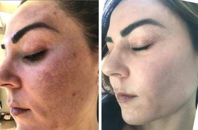 dermamelan peel near me