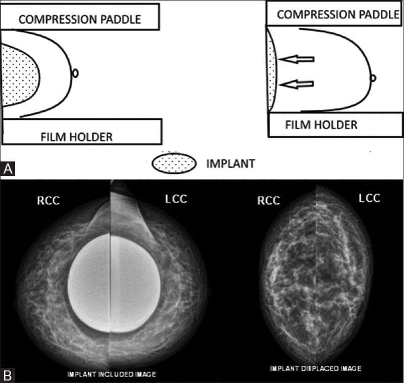 Breast Cancer Screening Implants