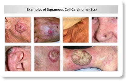 What is an SCC (Squamous Cell Carcinoma)?