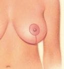 vertically down from the areola and horizontally along the breast crease