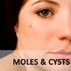 Moles and Cysts