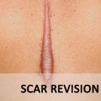 Scar Revision