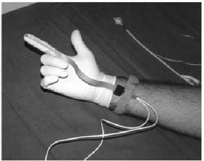 Sacral Nerve Stimulator