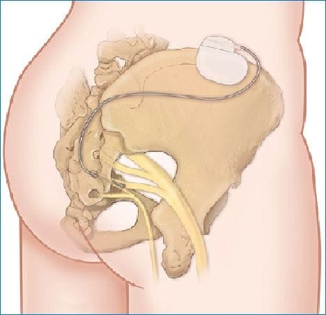 Obstetric-related Pudendal Neuropathies