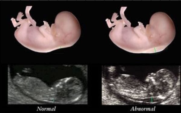 Translucency result nuchal ultrasound Normal reference